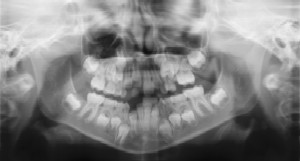 Dental Radiographs (X-Rays) - Pediatric Dentist in Keller, Fort Worth and Southlake, TX - Bridget McAnthony, DDS